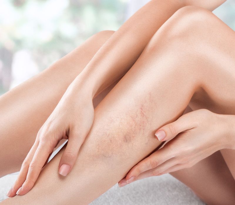 Vascular-Spider-vane-Treatments.jpg